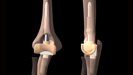 人工肘関節置換術 整形外科 ロッド 上腕骨コンポーネント 表面置換型 チタン合金 関節リウマチ 変形性肘関節症 上腕骨 尺骨