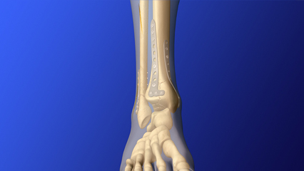 脛骨・腓骨固定 外科手術 脛骨骨折固定（distal tibia AL plate）脛骨プラトー骨折 整形外科 プレート固定 スクリュー固定 脛骨 腓骨