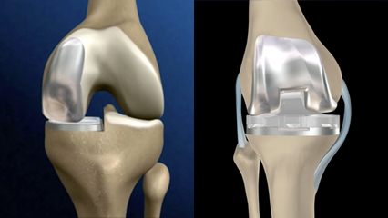 人工膝関節置換術（TKA・UKA） 整形外科 変形性膝関節症 関節リウマチ セラミック ポリエチレン 全人工膝関節置換術 単顆人工膝関節置換術 大腿骨 脛骨 腓骨