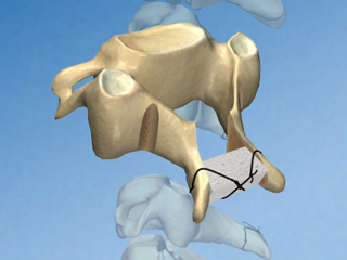 頚部脊柱管拡大術（スペーサー固定） 整形外科 頚椎 棘突起 脊柱管 人工骨