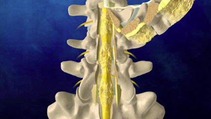椎弓還納式脊柱管拡大術 整形外科 腰部脊柱管狭窄症 脊椎 棘突起 椎弓形成術