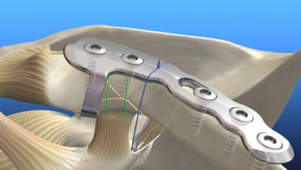 鎖骨遠位端骨折固プレート・スコーピオン 整形外科 スコーピンネオ （株）アイメディック 遠位骨片をフックで把持 肩鎖関節に干渉せず固定できる