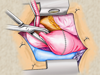 心臓弁膜症手術（イラスト） 大動脈遮断 大動脈横切開 カニューレ挿入 大静脈