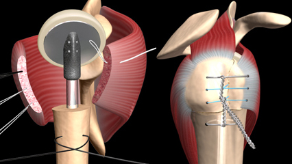 人工肩関節置換術 整形外科 上腕骨頭 関節窩 腱板 ジンマー 金属ヘッド ステム